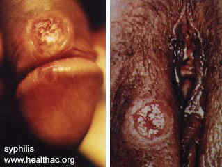 syphilis4.jpg