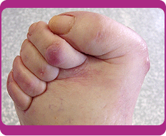 bunions_r1_c1.gif