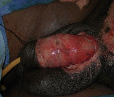 burnt dick.jpg
