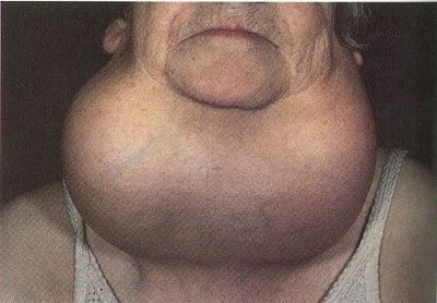 goiter.jpg