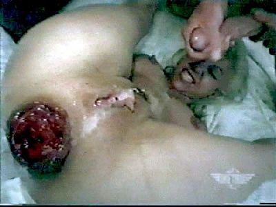 famous-mile-ass-prolapse.jpg