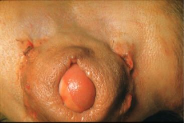 vag_prolapse_II.JPG