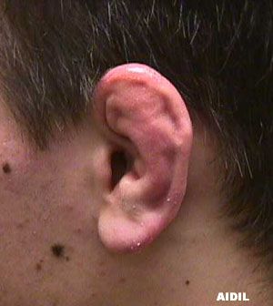cauliflowerear_1.JPG.jpeg