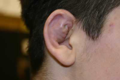 CauliflowerEar-1.jpg
