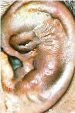cauliflower_ear.jpg
