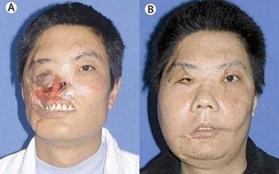 face-transplant-bea_794421c.jpg