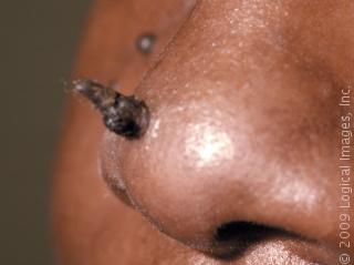 cutaneousHorn_1287_lg.jpg