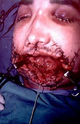 11608-horrible-facial-wartime-facial-woundsbig0.jpg