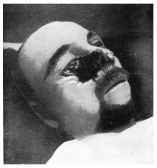 11608-horrible-facial-wartime-facial-woundsbig6.jpg
