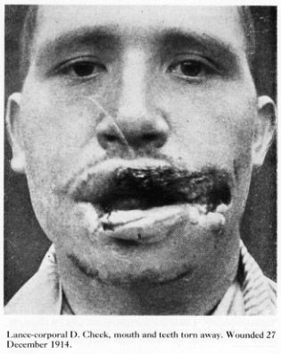 11608-horrible-facial-wartime-facial-woundsbig16.jpg