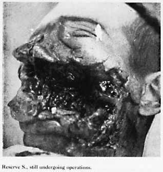 11608-horrible-facial-wartime-facial-woundsbig21.jpg