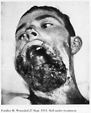 11608-horrible-facial-wartime-facial-woundsbig22.jpg