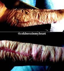 scarred%20forearms.jpeg