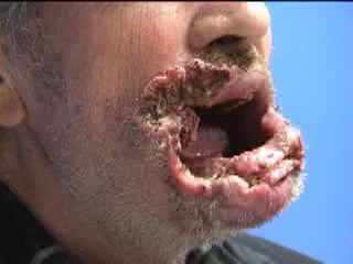 lip-eaten-away-1.jpg
