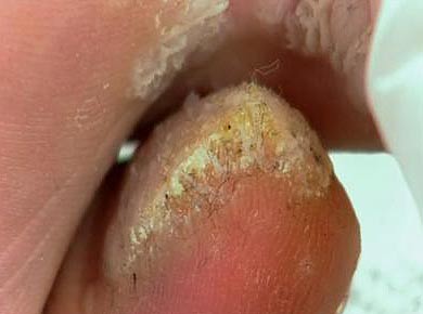 athletes_foot390x290.jpg