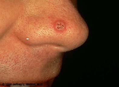 squamouscellcarcinoma-nose.jpg