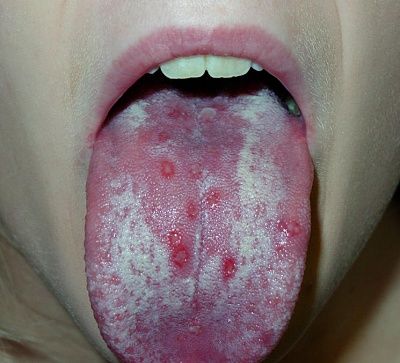 20071214-stomatitis-1c_small.jpg