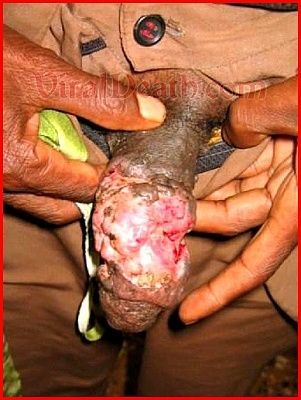 penis-cancer.jpg