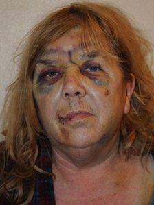 Name:  _57629941_christinefordhamwithinjuries.jpg
Views: 385
Size:  13.5 KB
