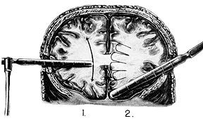 Name:  standard_lobotomy.jpg
Views: 6855
Size:  14.1 KB