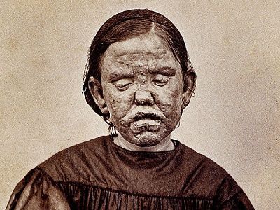 02_the_burns_archive_lepros_540x405.jpg