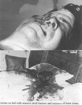 skull-fracture.jpg