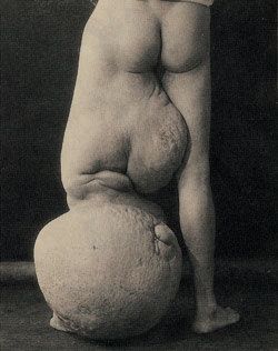 tumour-leg.jpg