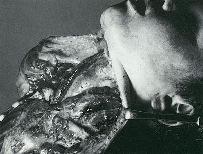 neck-autopsy.jpg