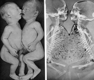 thoracopagus-twins.jpg