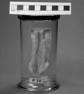 penis-gonorrhea.jpg