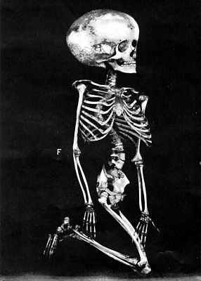 hydrocephalic_skeleton.jpg