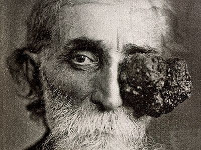 eye tumour.jpg