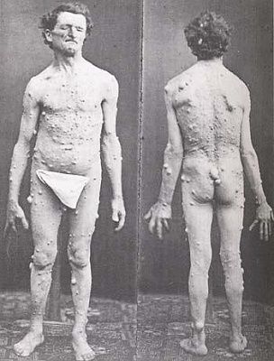 neurofibromatosis-1-.jpg