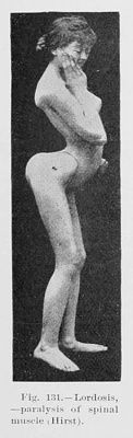 lordosis.jpg