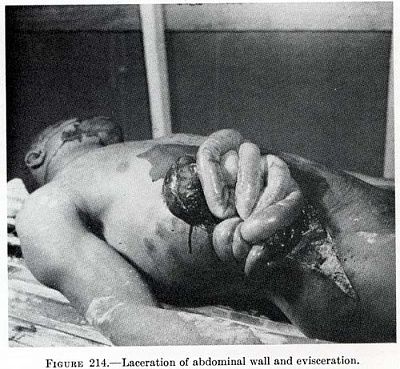 laceration-abdominal-walls-eviseration.jpg