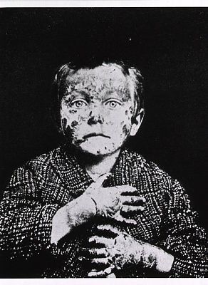 half-length-view-young-boy-severe-dermatitis-face-hands..jpg