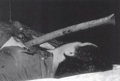impaled-injury-pipe.jpg