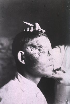 open-wound-soldier-s-face-c.-1905.jpg