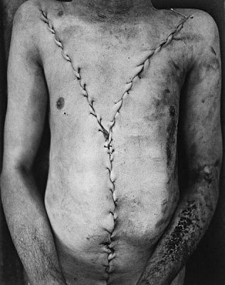 y-incision.jpg