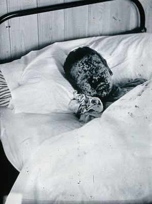 smallpox-2c-201896.jpg