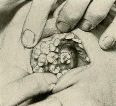 Supernumerary%20teeth%20in%20upper%20palate%20of%2015-year-old%20boy..jpg