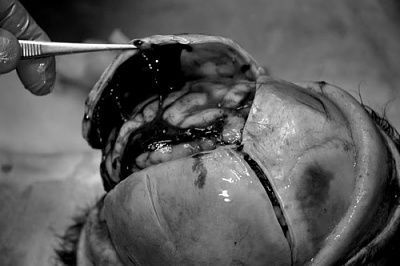 subdural-20hemorrhage..jpg