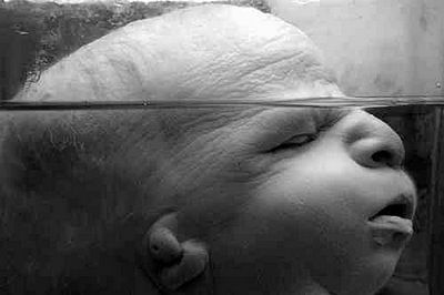 20fetus-20with-20treacher-collins-20syndrome..jpg