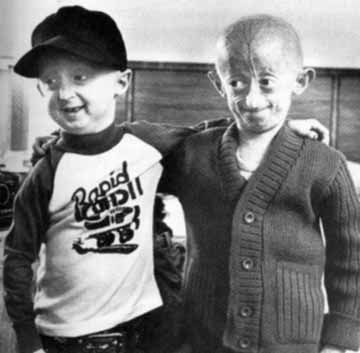 progeria-20-281-29.jpg