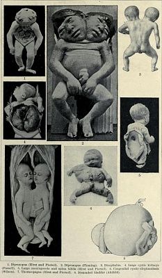 examples-20of-20the-20some-20of-20the-20various-20deformations-20of-20the-20fetus-20known-20to-2.jpg