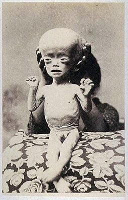 hydrocephaly1.jpg
