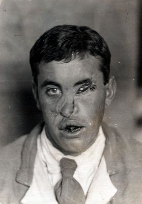 ww1_plastic_surgery_012.jpg