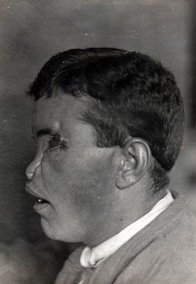 ww1_plastic_surgery_011.jpg