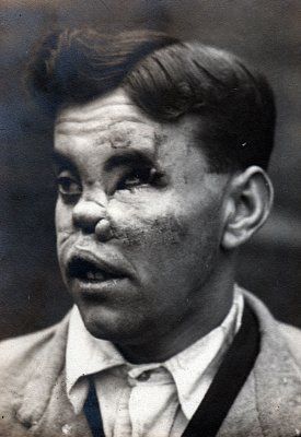ww1_plastic_surgery_013.jpg