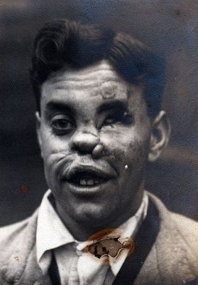 ww1_plastic_surgery_014.jpg